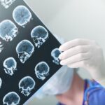 Concussions Are More Dangerous Than We Think