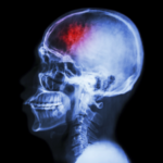 Anoxic Brain Injuries: Definition, Causes, and Medical Malpractice