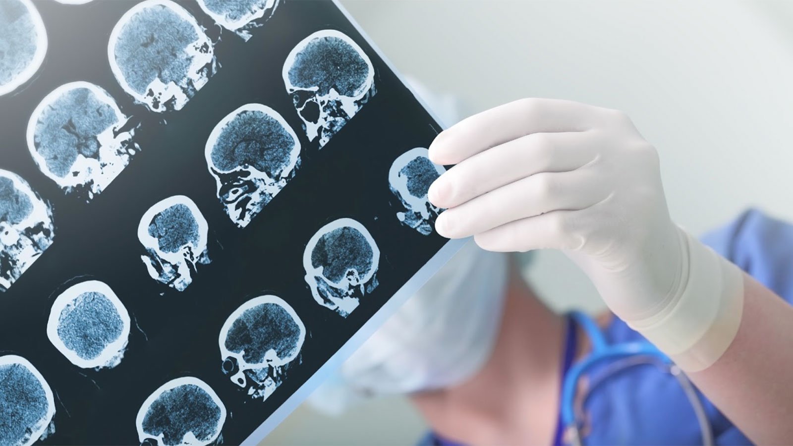 What are the Long-Term Effects of a Traumatic Brain Injury