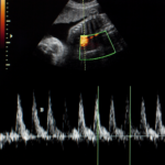 How Do You Prove Negligence for Failure to Monitor Maternal or Fetal Health?