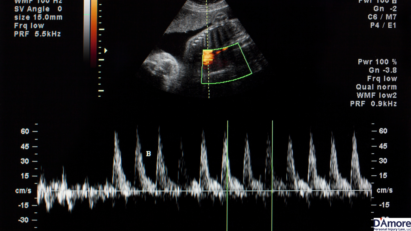 How Do You Prove Negligence for Failure to Monitor Maternal or Fetal Health?